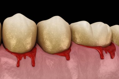 Diş eti kanaması ya da Periodontal - sakız ve kemik desteğinin patolojik iltihaplanma durumu. Diş 3B illüstrasyon