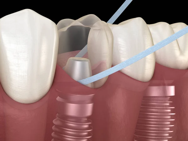 Implantaat Tandreiniging Met Tand Floss Medisch Nauwkeurige Illustratie — Stockfoto