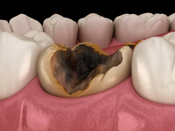 Molární Zub Poškozený Caries Lékařsky Přesná Zubní Ilustrace — Stock fotografie