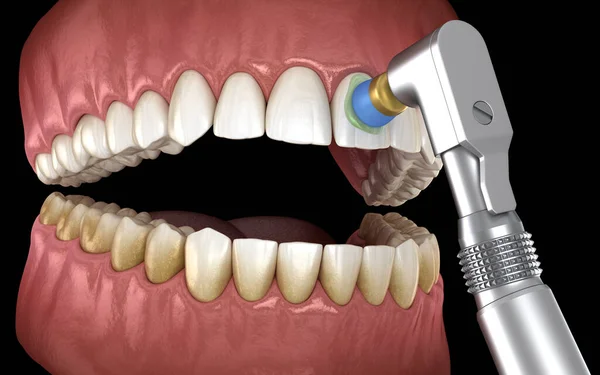 プロのブラシとゲルで歯研磨手順 医学的に正確な3Dイラスト — ストック写真
