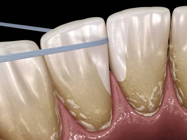 Гигиена Полости Рта Использование Зубной Нити Удаления Бляшек Медицинская Точность — стоковое фото