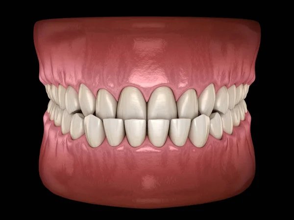 Подкусывание Зубов Малокклюзия Зубов Медицинская Точность Трехмерной Иллюстрации Зубов — стоковое фото
