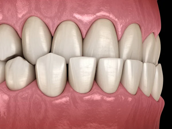 咬牙咬紧 牙齿的闭塞 医学上精确的牙齿 — 图库照片