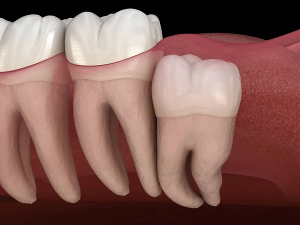 モル歯にインプレクションを伴う知恵の歯 医学的に正確な歯3Dイラスト — ストック写真