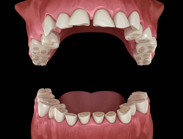 Tandheelkundige Uitputting Bruxisme Resulterend Verlies Van Tandweefsel Medisch Nauwkeurige Tand — Stockfoto