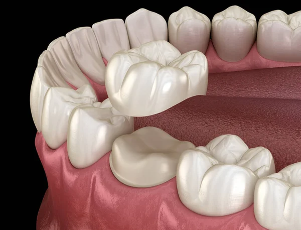 Dintele Molar Preparat Pentru Plasarea Coroanei Dentare Ilustrație Precisă Medical — Fotografie, imagine de stoc