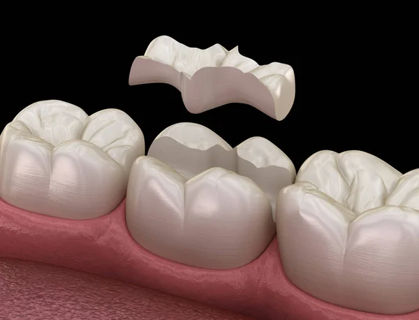 Inlay ceramic crown fixation over tooth. Medically accurate 3D illustration of human teeth treatment