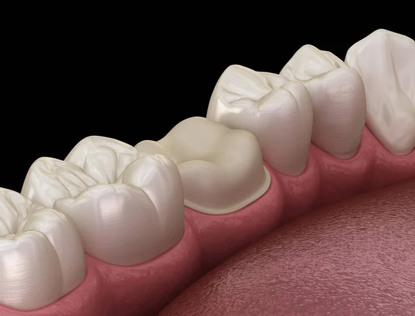 Dintele Molar Preparat Pentru Plasarea Coroanei Dentare Ilustrație Precisă Medical — Fotografie, imagine de stoc