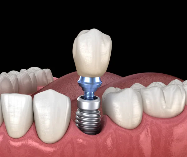 Prämolare Zahnsanierung Mit Implantat Medizinisch Genaue Abbildung Des Konzepts Menschlicher — Stockfoto