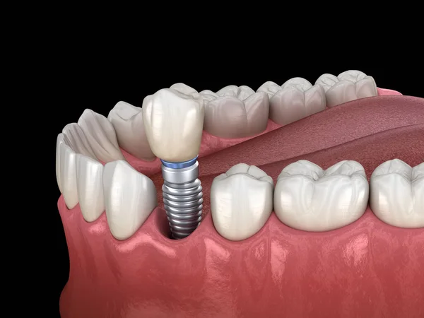 Implantátummal Helyreállt Fogszuvasodás Orvosilag Pontos Illusztráció Emberi Fogak Műfogsor Koncepció — Stock Fotó