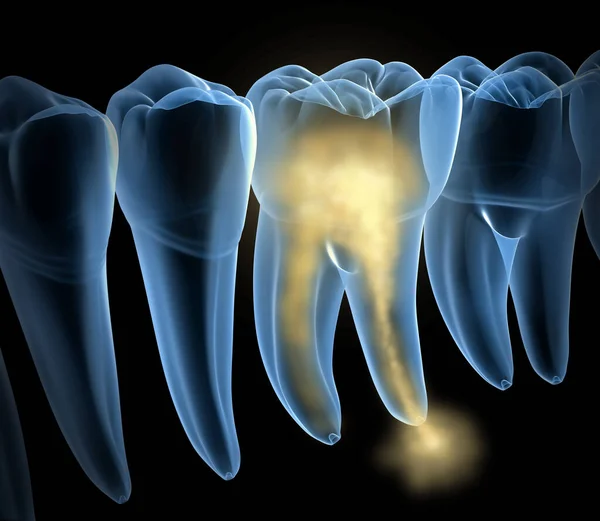 Поврежденный Зуб Xray Зрения Медицинская Точность Трехмерной Иллюстрации Зубов — стоковое фото