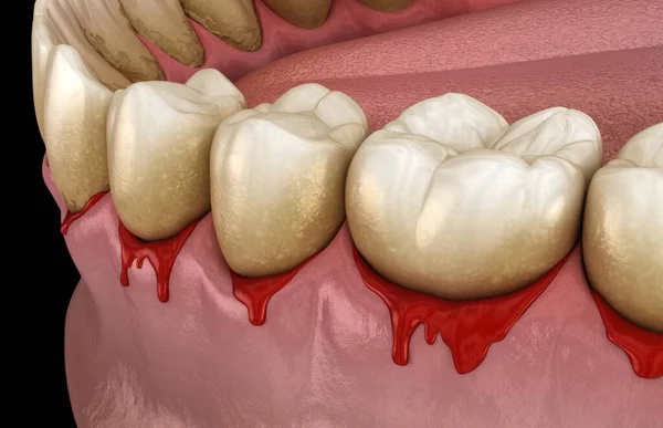歯茎や歯周病 歯茎や骨のサポートの病理学的炎症状態 歯科用3Dイラスト — ストック写真