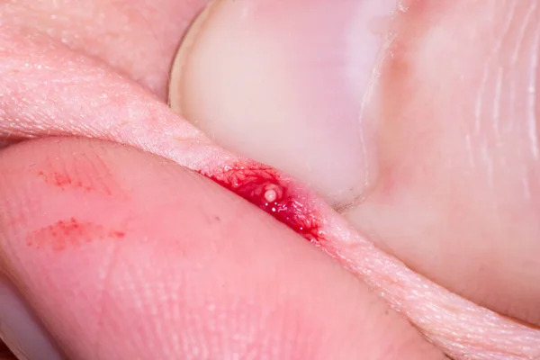 Espinilla con sangre en la piel humana entre los dedos . — Foto de Stock