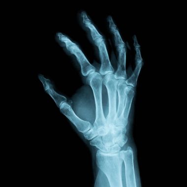 insan bir sağ bir tıbbi tanı için x-ray görüntüsü