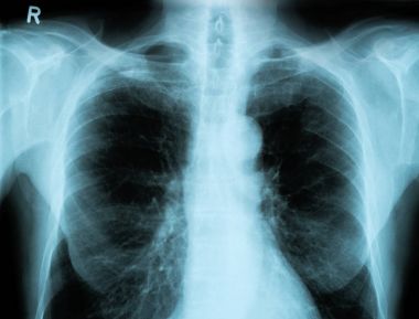 İnsan Göğsünün X-Ray Görüntüsü