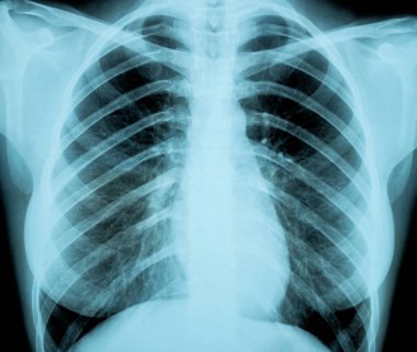 X-Ray görüntü, kadın göğüs tıbbi tanı için