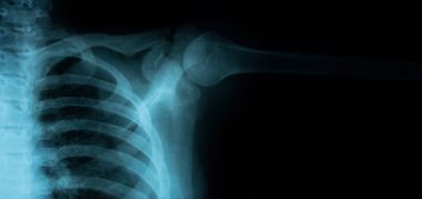 Sağlıklı göğüs X-Ray görüntüsü