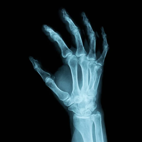 Raio-X Imagem de uma mão direita humana para um diagnóstico médico — Fotografia de Stock