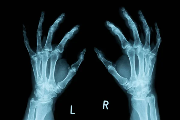 X-ray Image des deux mains humaines — Photo