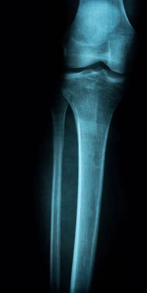 Imagem de raio-X de uma perna de um diagnóstico médico — Fotografia de Stock