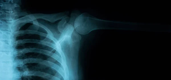 Röntgenbild av friska bröstet — Stockfoto