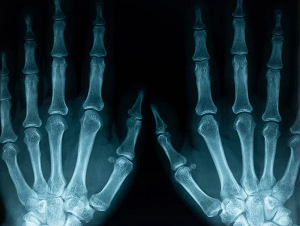 X-ray närbild av händer — Stockfoto