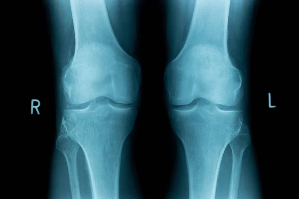 x-ray image of both human knee