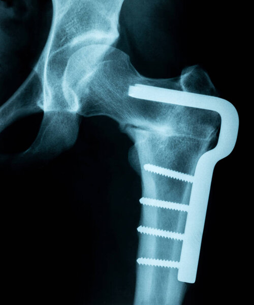X-Ray Image of a broken pelvis/hip with metal pins holding it to