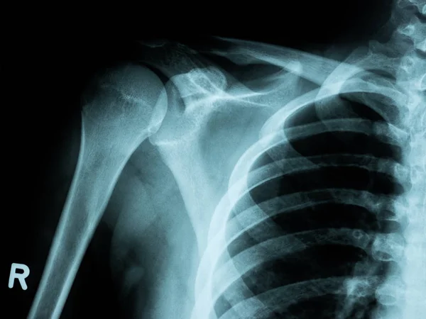 Imagen de rayos X de fractura de hombro para un diagnóstico médico —  Fotos de Stock