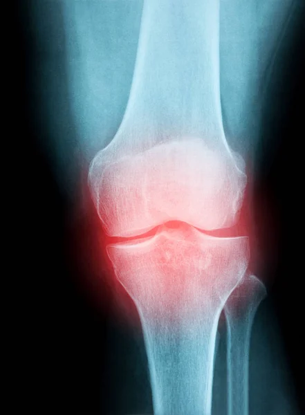 Röntgen bild av en mänsklig knäleden för en medicinsk diagnos — Stockfoto