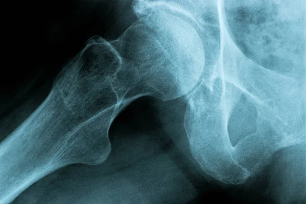 Imagem de raio-X de uma articulação do tórax humano osso da anca — Fotografia de Stock