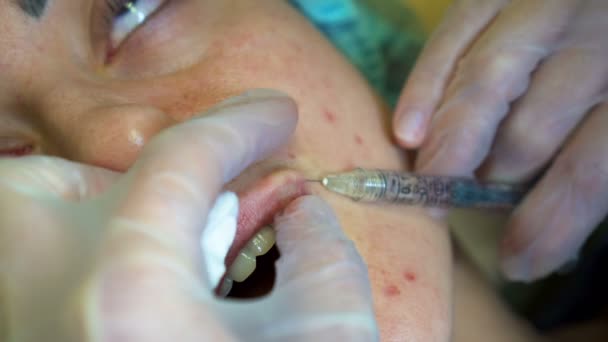 Kosmetolog göra injektion plast läppar. Ung kvinna på lip Augmentation i en klinik — Stockvideo