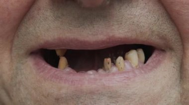 Çürük dişlerini gösteren bir adam. Periodontal hastalık. Protezden önce dişleri gördüm. Bakımlı dişler..