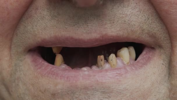 Ένας άντρας δείχνει τα σάπια δόντια του. Περιοδοντική νόσος. Πριόνισε τα δόντια πριν την προσθετική. Δόντια με τερηδόνα. — Αρχείο Βίντεο