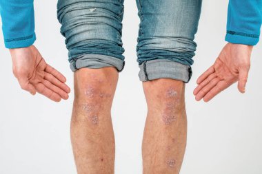 Close-up of the legs of a man suffering from chronic psoriasis o clipart