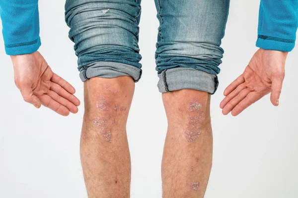 Primer plano de las piernas de un hombre que sufre de psoriasis crónica o — Foto de Stock