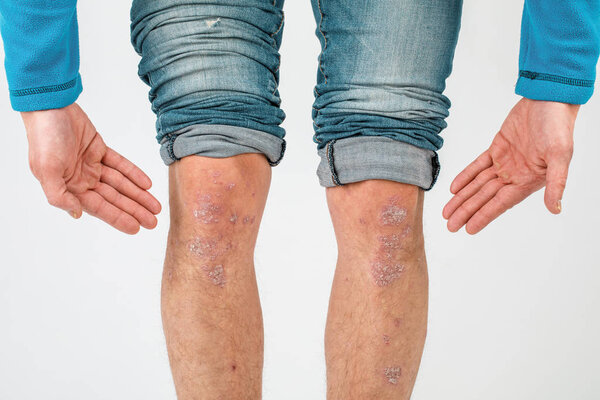 Close-up of the legs of a man suffering from chronic psoriasis o