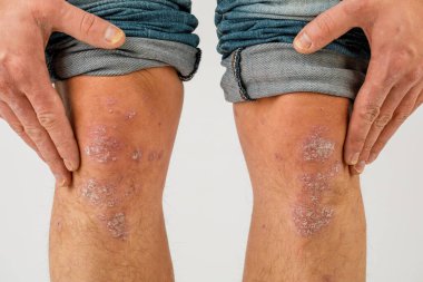 Kronik sedef hastalığından muzdarip bir adamın bacaklarının yakın çekimi.