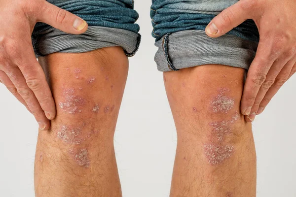 一名患有慢性银屑病的男子的腿部特写 — 图库照片