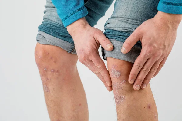 Primer plano de las piernas de un hombre que sufre de psoriasis crónica o —  Fotos de Stock