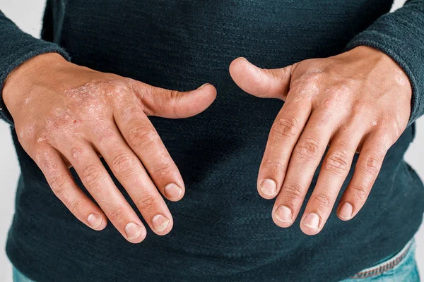 Hasta elleri olan adam, kaba psor ile elinde kuru pul pul deri — Stok fotoğraf