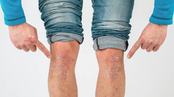 Close-up of the legs of a man suffering from chronic psoriasis o