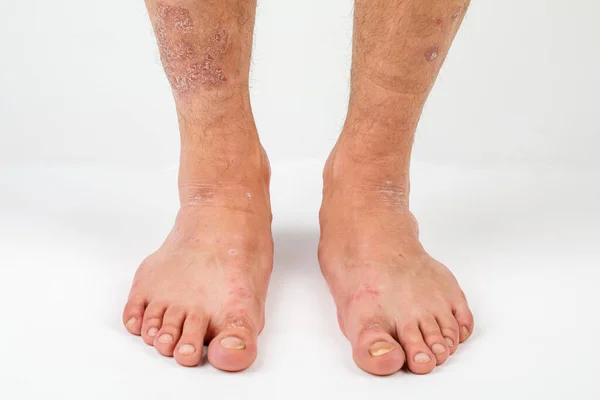 Beyaz Arka Planda Kronik Sedef Hastası Bir Adamın Bacaklarının Yakın — Stok fotoğraf