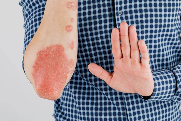 Man with sick hands, dry flaky skin on his hand with vulgar psoriasis, eczema and other skin diseases such as fungus, plaque, rash and blemishes. Autoimmune genetic disease.