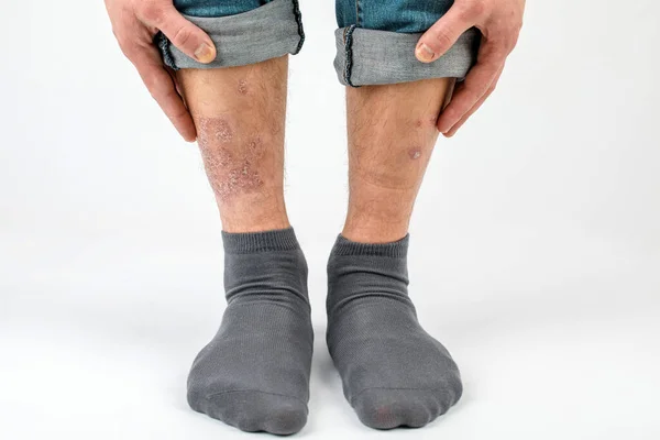 Close-up of the legs of a man suffering from chronic psoriasis on a white background