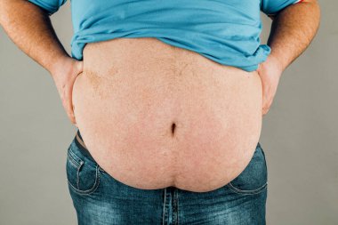 Elleri karnına dokunan bir kişinin aşırı kilolu vücudu. Obezite kavramı.