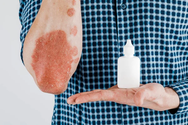 Aplicación Emoliente Sobre Piel Seca Como Tratamiento Psoriasis Eccema Otras — Foto de Stock