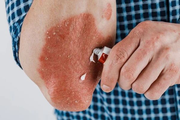 Aplicação Emoliente Pele Seca Como Tratamento Psoríase Eczema Outra Pele — Fotografia de Stock