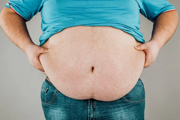 Overweight of a person\'s body with hands touching the abdomen. The concept of obesity.