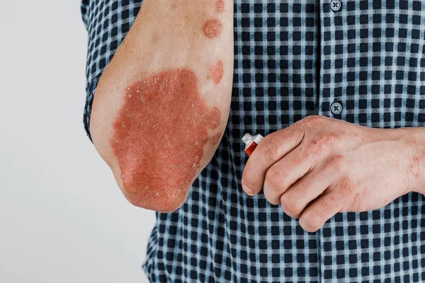 润肤液在干性皮肤上的应用 如银屑病 湿疹和其他干性皮肤的治疗 — 图库照片